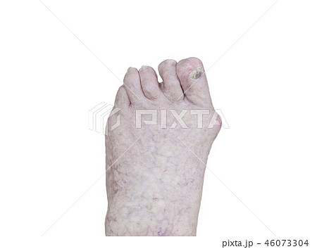 old person's foot with arthritis, damaged nails old person's foot with arthritis, damaged nails 46073304