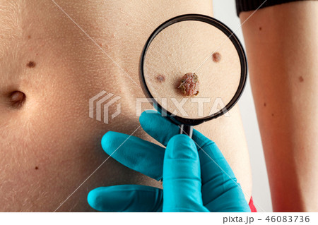 Birthmark. Dermatologist examines mole. 46083736
