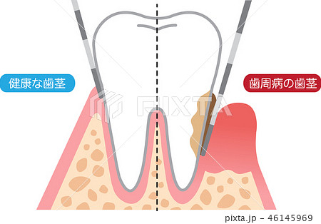 歯周病の歯茎と健康な歯茎のイラスト素材
