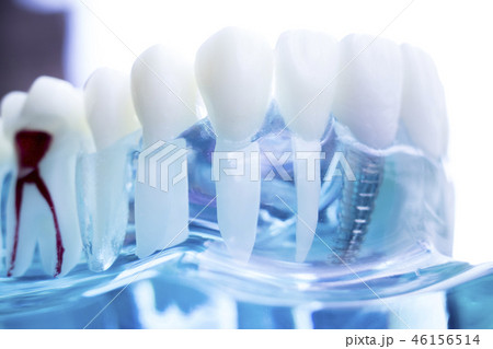 Dentist dental teeth implant Dentist dental teeth implant 46156514