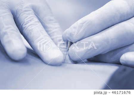 Dry needling EPI needle 46171676