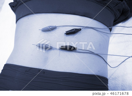 Dry needling EPI needle 46171678