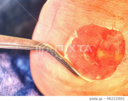 Cut treatment of dead skin and abrasions on heel. 46222001