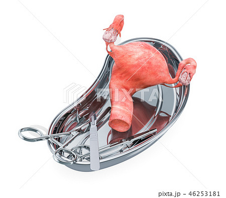 Surgery uterus or transplantation concept 46253181