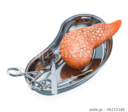 Pancreatic operation or transplantation concept Pancreatic operation or transplantation concept 46253186