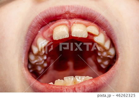 Close-up of child of eight years with the problem of not loosing his baby teeth 10 month after 46262325