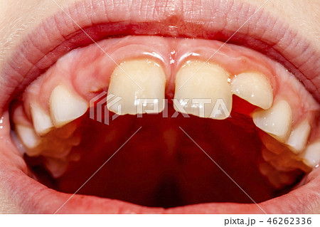 Close-up of child of eight years with the problem of not loosing his baby teeth 10 month after Close-up of child of eight years with the problem of not loosing his baby teeth 10 month after 46262336
