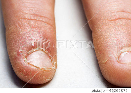 Close up of hand with bitten finger and fingernails. 46262372