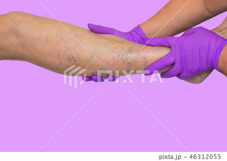 Lower limb vascular examination because suspect of venous insufficiency. 46312055