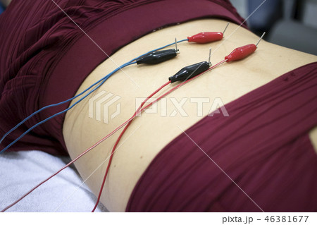 Dry needling EPI needle Dry needling EPI needle 46381677