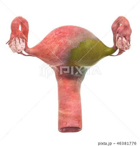 Uterine diseases concept. 3D rendering 46381776