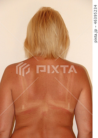 Back burnt after sunburn. Female body.  46395234