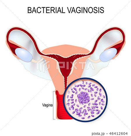 Gardnerella Vagina