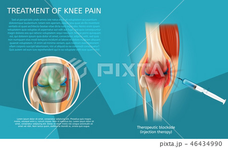 Realistic Illustration Treatment of Knee Pain 46434990