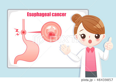 Prevention esophageal cancer Prevention esophageal cancer 46439857