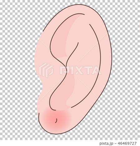 ピアス　耳　化膿　腫れる　耳たぶ 46469727