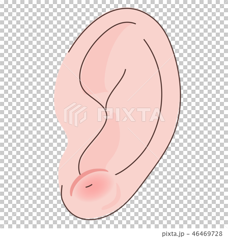 ピアス　耳　化膿　腫れる　肉芽 46469728