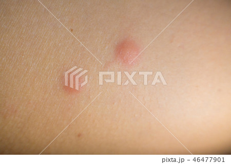 Insect bites on female hand 46477901