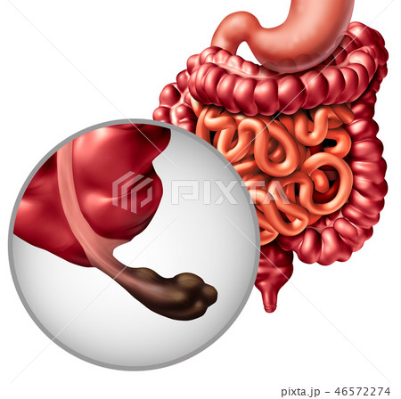 Appendix Cancer Appendix Cancer 46572274