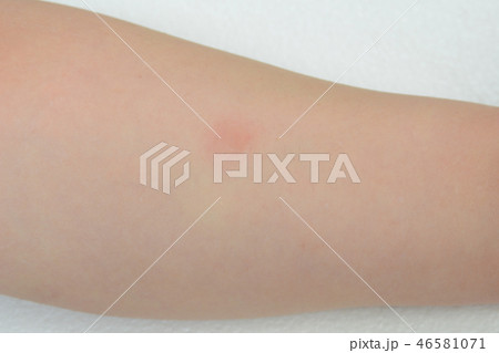 ツベルクリン反応検査 アップ ツベルクリン反応検査 アップ 46581071