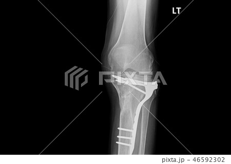 internal of left leg fixed with plate and screws. 46592302