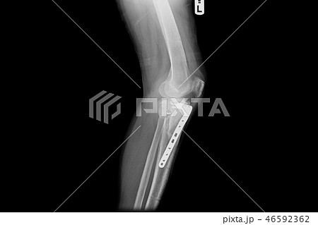 internal of left leg fixed with plate and screws. 46592362