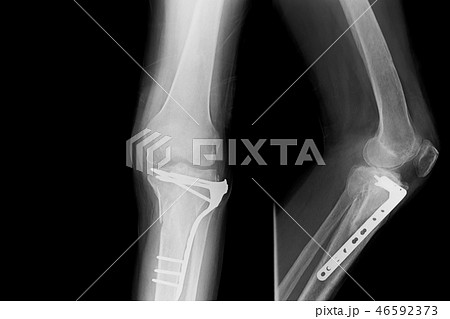 x-ray both leg and show external fixation of them. 46592373