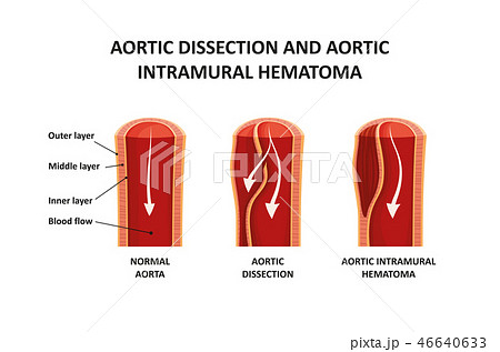 Aortic dissection and aortic intramural hematoma 46640633