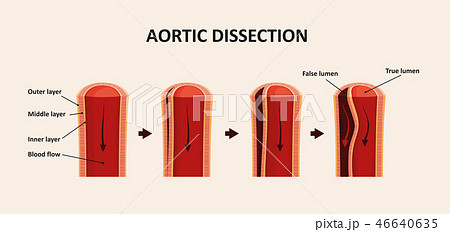 Aortic Dissection, Aortic Aneurysm Aortic Dissection, Aortic Aneurysm 46640635