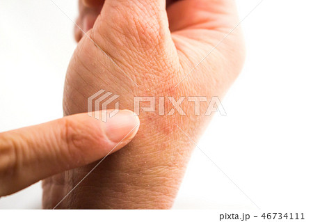 あかぎれ　軽度 46734111