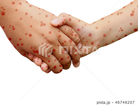 Measles Disease 46749207
