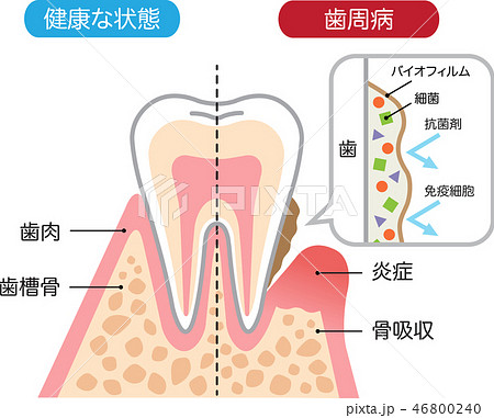 健康な歯と歯周病 バイオフィルム 断面図のイラスト素材
