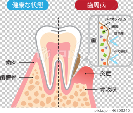 Healthy teeth and periodontal disease biofilms cross section 46800240
