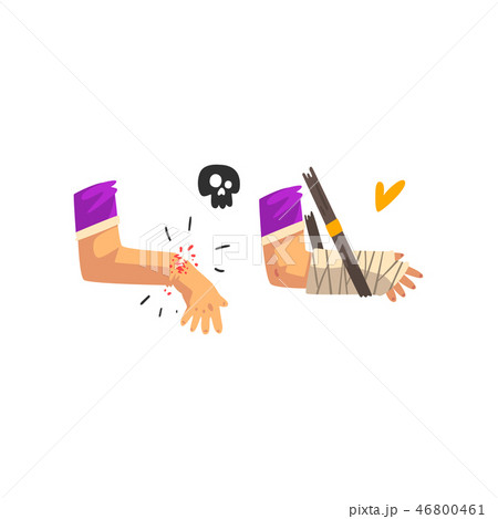 Fracture of the wrist, hand plastered, physical injury, first aid and treatment vector Illustration 46800461