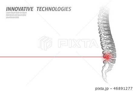Laser physiotherapy human spine injury. Pain area surgery operation modern loin medicine technology 46891277