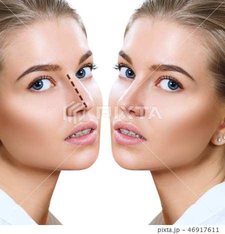 Female nose before and after cosmetic surgery. Female nose before and after cosmetic surgery. 46917611