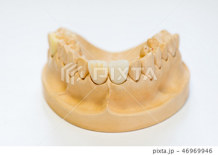 Dental gypsum model  46969946