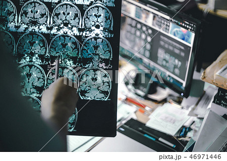 alzheimer's disease on MRI 46971446