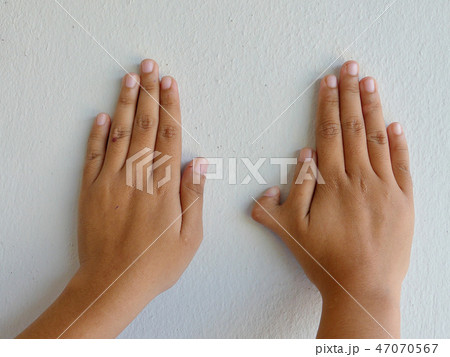 Polydactyly on human; rare abnormal characteristic 47070567