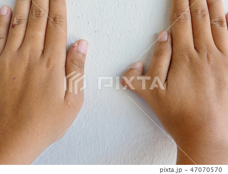Polydactyly on human; rare abnormal characteristic Polydactyly on human; rare abnormal characteristic 47070570