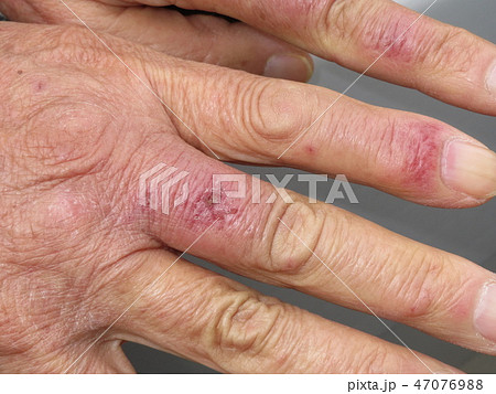 しもやけ しもやけ 47076988