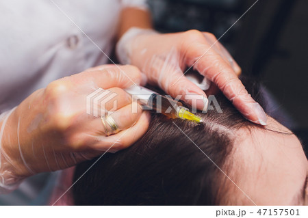 Platelet rich plasma injection procedure. Hair growth stimulation. PRP therapy process. Platelet rich plasma injection procedure. Hair growth stimulation. PRP therapy process. 47157501