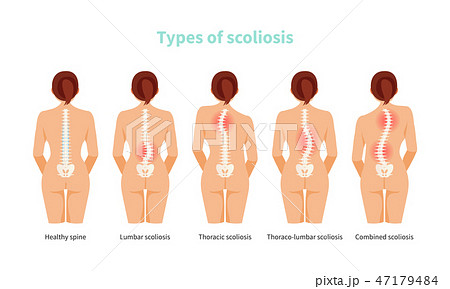 Types of scoliosis vector Types of scoliosis vector 47179484