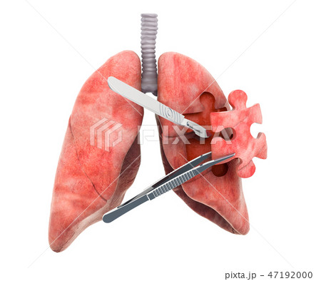 Lungs surgery concept, 3D rendering 47192000