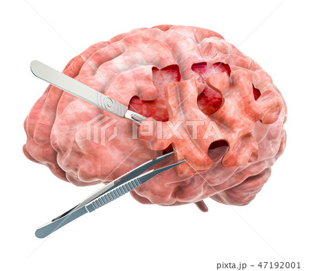 Brain surgery concept. 3D rendering Brain surgery concept. 3D rendering 47192001