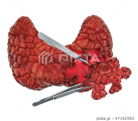 Thyroid surgery concept, 3D rendering 47192002