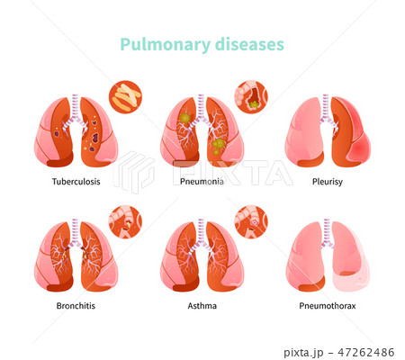 Pulmonary disease vector 47262486