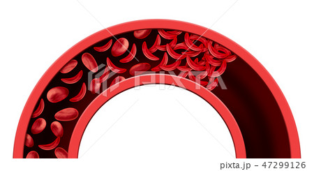 Sickle Cell Blood Vessel Blockage 47299126