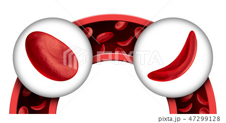 Sickle Cell Disease Sickle Cell Disease 47299128
