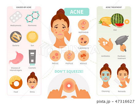 Acne infographic vector 47316627